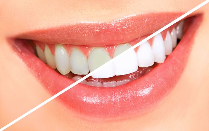 Albește-ți dinții mult mai ușor și fără durere cu noile tehnologii