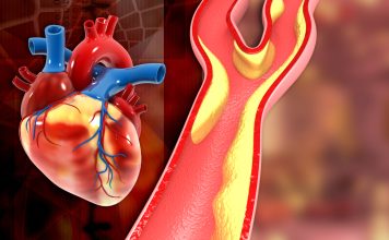 12 metode prin care poţi preveni apariţia unui infarct miocardic 12 metode prin care poţi preveni apariţia unui infarct miocardic